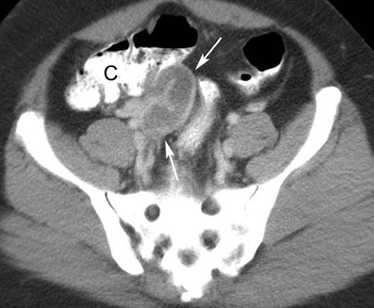 , xial CT scan obtained inferior to shows fat stranding (open arrows) surrounding right ovary (O).