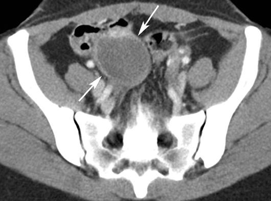 Helical CT of cute RLQ Pain Fig. 8. 41-year-old man with right lower quadrant (RLQ) pain.