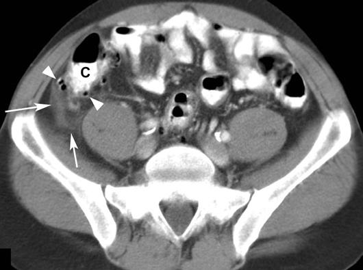 consistent with obstruction. Final diagnosis was right ureteropelvic obstruction. Fig. 9.