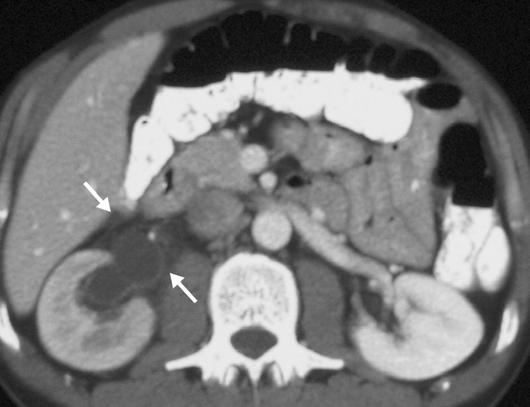xial CT scan shows cystic structure in right adnexa (arrows) with well-defined wall most likely