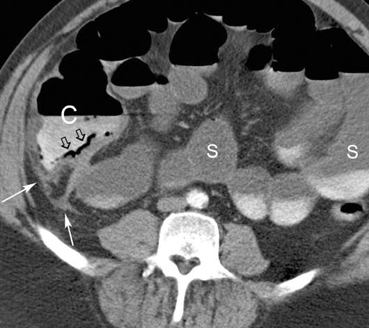 Yu et al. Fig. 11. 23-year-old man with right lower abdominal pain.