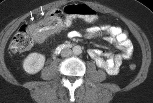 42-year-old woman with right abdominal pain.