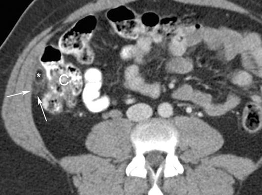xial CT scan shows wall thickening of cecum (C) with pneumatosis (open arrows) and pericecal fat stranding (solid arrows).