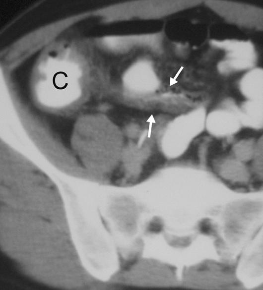 Helical CT of cute RLQ Pain Fig. 15. 45-year-old man with Salmonella ileocolitis. xial CT scan shows thickened cecum (C) and terminal ileum (arrows), with latter mimicking abnormal appendix.