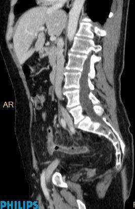 Sagital (a) and axial (b-c) MDCT images with