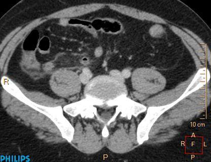year-old man with acute gangrenous appendicitis