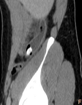 images in 17 years-old man showing CT signs