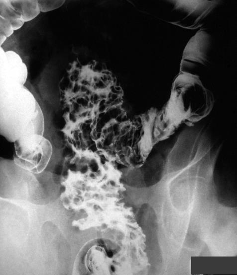 iatrogenic Bowel wall pneumatosis
