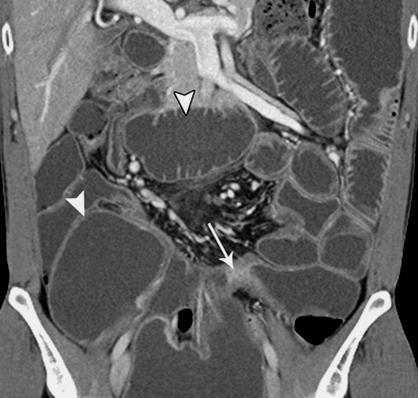 Diffuse/segmental gas/fluid levels Obstruction Small bowel Adhesion Crohn s Neoplasm Hernia Radiation