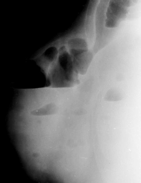 Crohn s Neoplasm Hernia Radiation