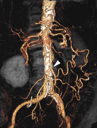 Pathological circulation Arterial thromboembolism (MI, rheumatic heart disease, atrial