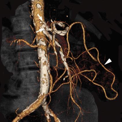 ) arteriosclerosis dissection heart failure others (iatrogenic, idiopathic,