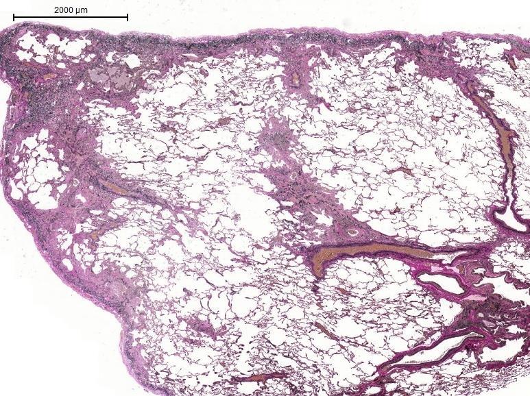 UIP Fibrosis along the pleura, interlobular septa,