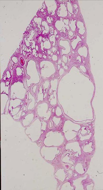 Histology of Honeycombing MB ( alveolar tip)