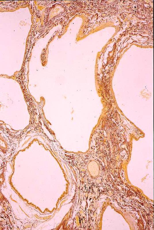ducts in the cyst wall with smooth muscle hyperplasia.