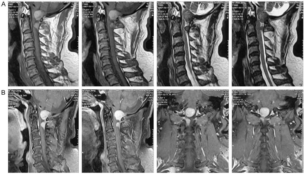 Figure 1. A. Magnetic resonance image (MRI) of cervical spine showed that clumps of short T1 at the rear the foramen magnum were mixed with T2 signal lesions; B.