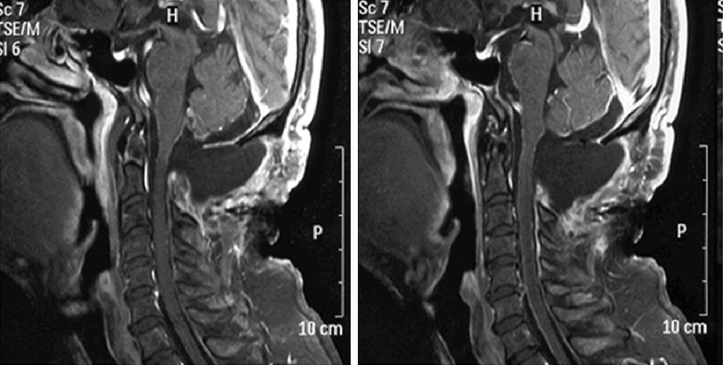 Figure 6. Symptomatic treatment was adopted and the reexamination three months later showed that original lesions had been removed and the patient was recovering in good condition without recurrence.