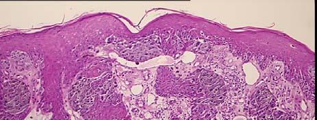 Spitzoid Melanoma the classic Spitzoid melanoma is seen mainly in the pediatric population most commonly in the head and neck the differential diagnosis is primarily