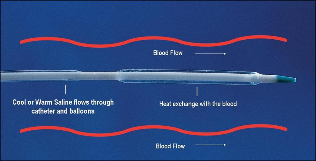 How the Catheters Work Cool or warm saline flows within the balloons Blood is cooled or
