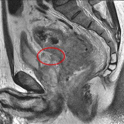 T2-weighted high resolution image, axial plane. Fig 4. Rectal cancer patient, 52 year-old man.