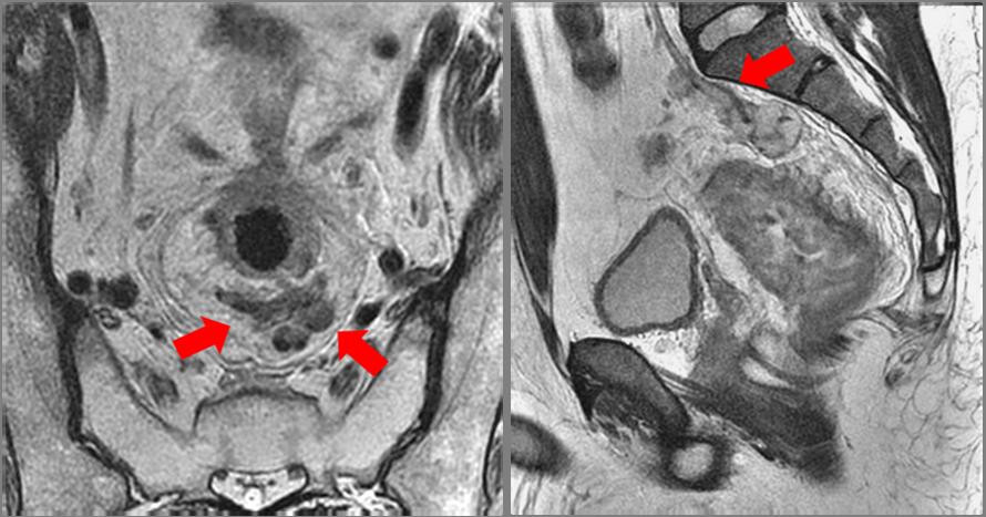 Fig. 6. A. Rectal cancer patient, 68 year-old man. The T2-weighted high resolution image, axial plane, displays the presence of extramural vascular invasion.