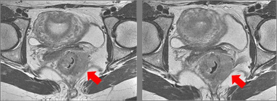 Fig. 8. A and B. Patient with low rectal tumor, 54 year-old woman.