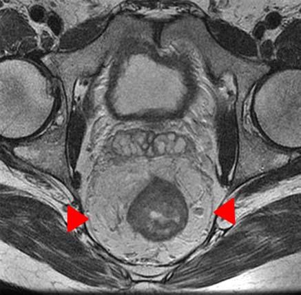 Fig.1. A. Patient with rectal cancer, 50 year-old man. T2-weighted high-resolution image, axial plane, showing the mesorectal fascia (arrowheads). B. Patient with rectal cancer, 52 year-old man.