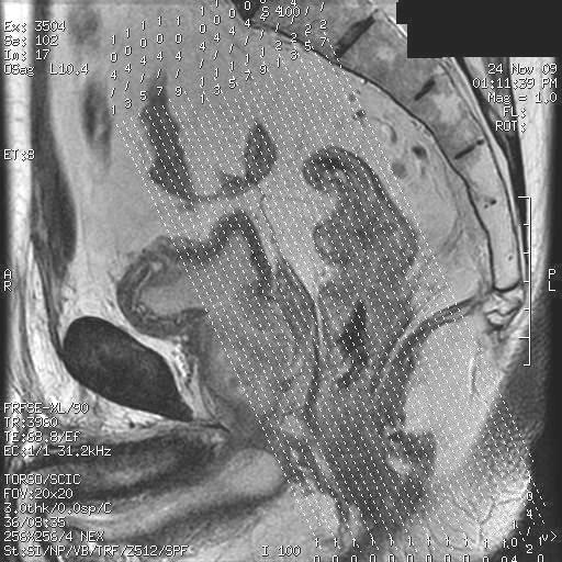 rectum, at the site of the tumor, from the sacral