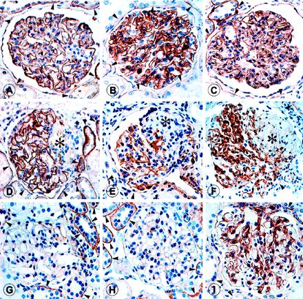 Glomerular expression of dystroglycans is reduced in MCD but not in FSGS Regele