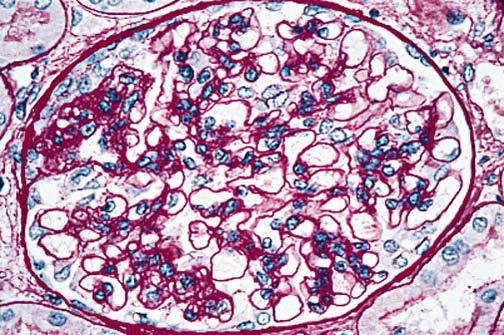 Idiopathic FSGS Is idiopathic really idiopathic? MYH9 is a major-effect risk gene for FSGS. (Kopp et al.