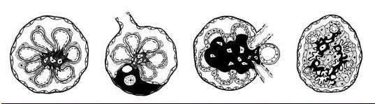 Podocytopathies: 4 morphologic patterns of glomerular injury Normal