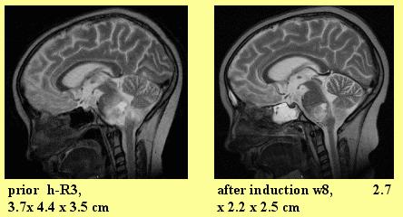 MRI Scans : Before and