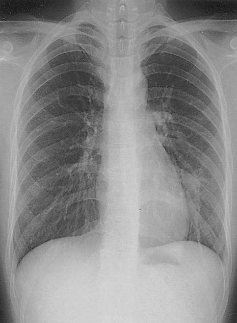 84 The Korean Journal of Internal Medicine: Vol. 21, No. 1, March, 2006 A B Figure 1. (A) Posteroanterior chest radiograph revealing the dense left lower lobe opacity on admission.