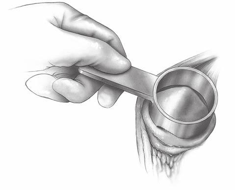 Apply the patella reamer clamp at a 90 degree angle to the longitudinal axis with the patella reamer insetting guide on the articulating surface.
