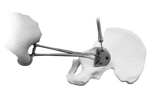 Insert the Acetabular Augment implant using the Augment Implant Forceps. Pre-drill bone holes as needed (B).