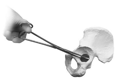 2Restrictor Insertion Select the Acetabular Restrictor implant that matches the size selected when using the Sizing Tamp.