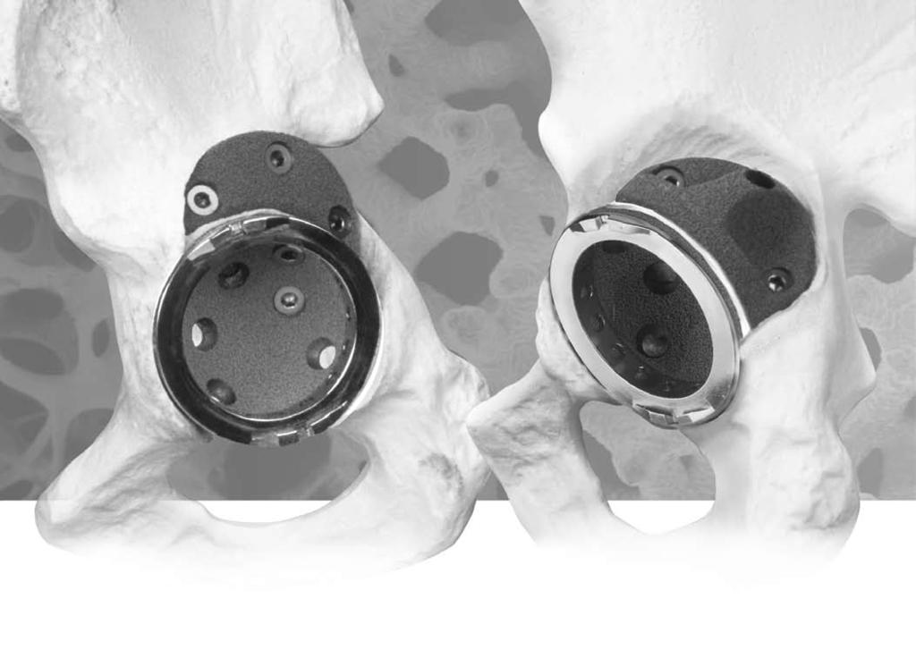 Trabecular Metal Acetabular Restrictor and Augment Bone Void Filler The Augment and Restrictor fill bone deficiencies as an alternative to preparing and using structural allografts.