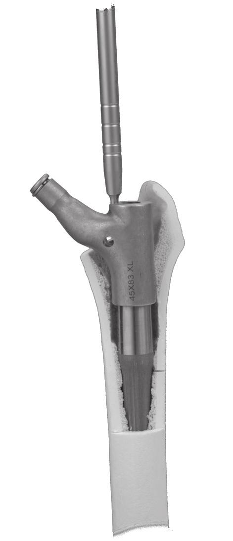 ZMR Over-the-Junction Instruments for Revision Hip Arthroplasty 7Using Metal Proximal Provisionals Select the desired Metal