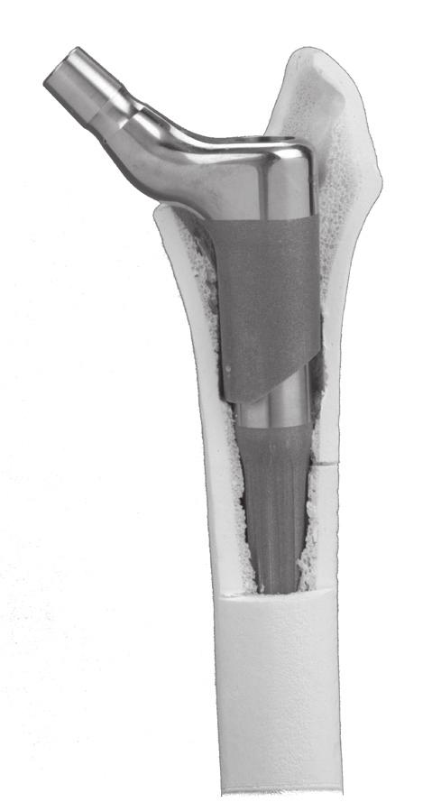 Note: The MPP locks onto the taper of the definitive distal stem.