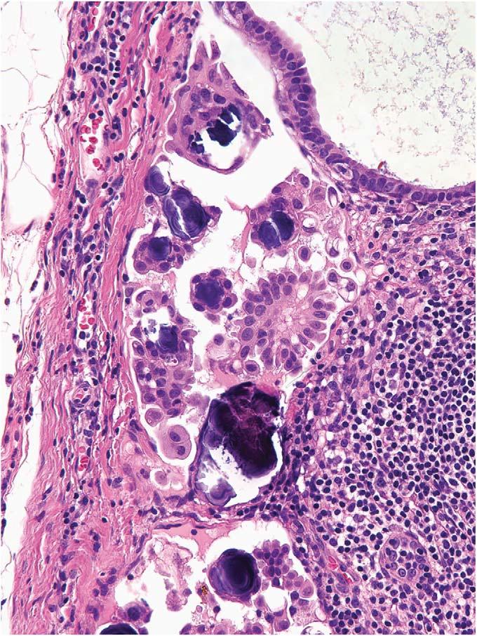 Am J Surg Pathol Volume 30, Number 5, May 2006 Serous Borderline Tumors Individual Cells, Clusters of Cells, and Simple Papillae Twenty-eight of 31 (90%) patients with LNI had an admixture of single