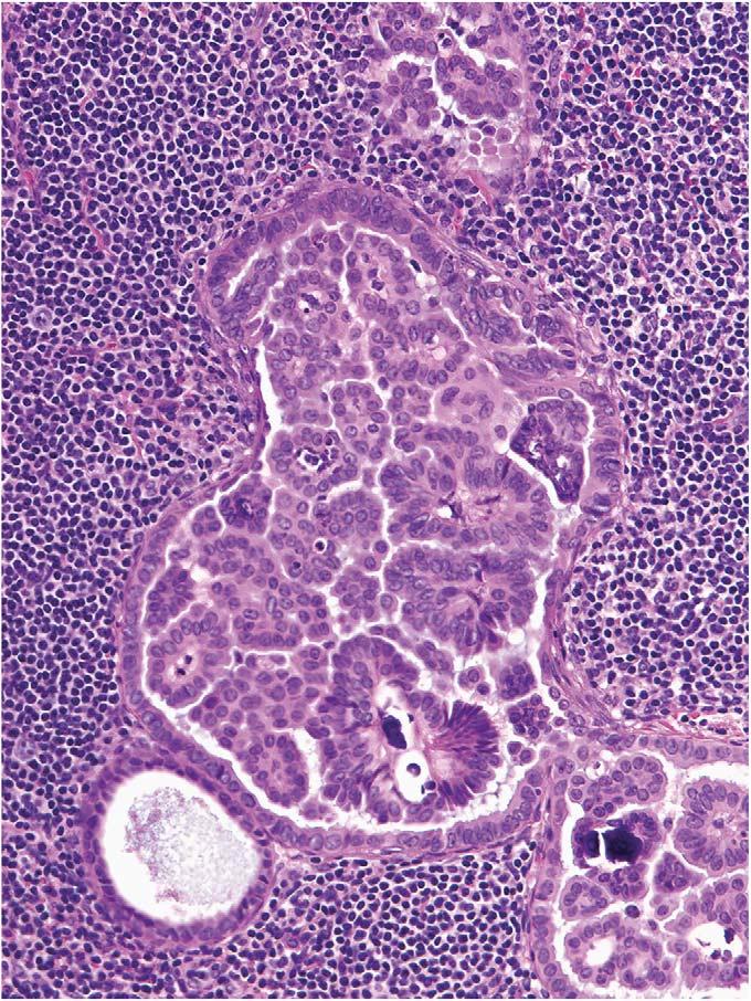 Five of these patients had stromal microinvasion and four had micropapillary architecture in the primary ovarian tumor.
