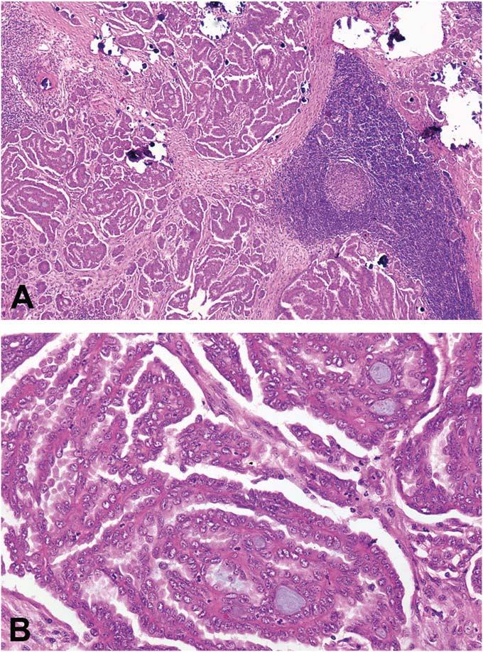 Note the stromal response associated with a glandular pattern at right. microinvasion (Fig. 3).