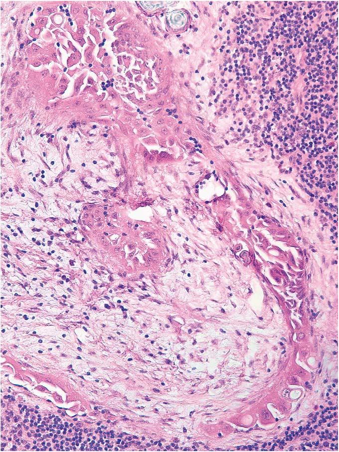Am J Surg Pathol Volume 30, Number 5, May 2006 Serous Borderline Tumors were associated with endosalpingiosis, compared with 16 of 26 (62%) nonmicropapillary cases.