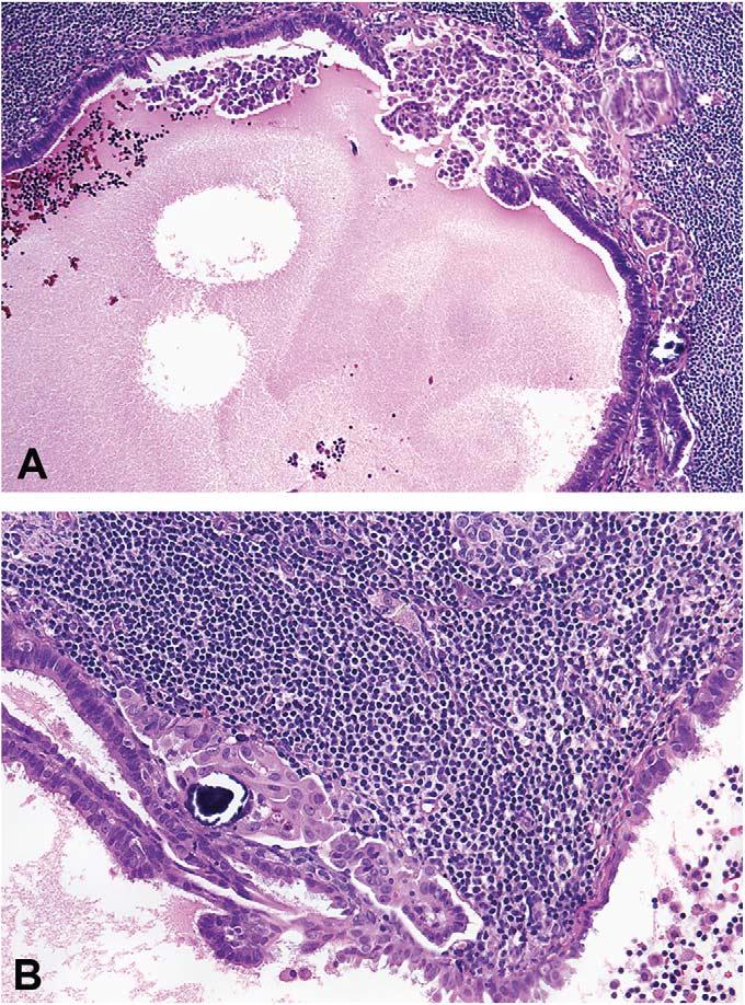 McKenney et al Am J Surg Pathol Volume 30, Number 5, May 2006 FIGURE 9. Partial endosalpingiotic gland involvement with stromal microinvasion pattern.