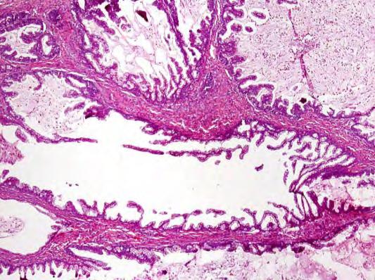 Tumors with admixed cystadenoma, borderline tumor, and invasive carcinoma Pathogenesis of Surface Epithelial Type Mucinous Tumors Molecular evidence: Cuatrecasas, Cancer 1997: KRAS mutations in