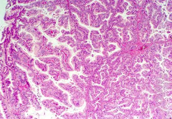 borderline tumor + carcinoma Conclusion: KRAS mutation is early event Mucinous Cystadenoma Mucinous Borderline Tumor Invasive Well-differentiated Mucinous Carcinoma (Confluent Pattern) Pathogenesis