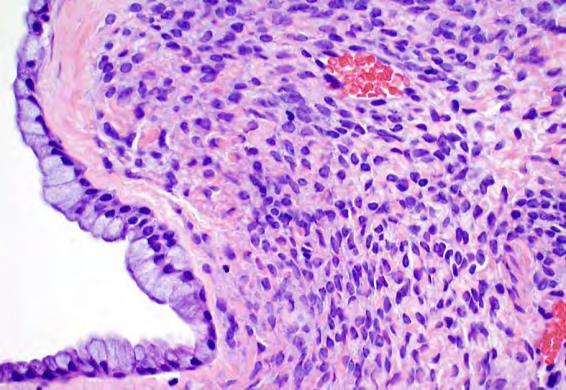 least 1 pathway Question: Are all GI type surface epithelial mucinous tumors of Brenner origin?