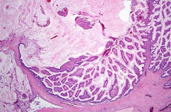 2/5/2013 Pathogenesis of Primary Ovarian Mucinous Tumors: Germ Cell (Teratomatous) Origin?