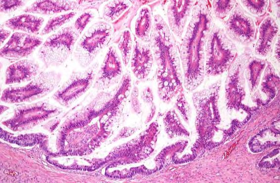 Respiratory epithelium Upper GI tract Proposal: Mucinous tumors may arise from teratomas Other somatic type tumors arising from teratomas: Thyroid tissue Papillary thyroid carcinoma Squamous