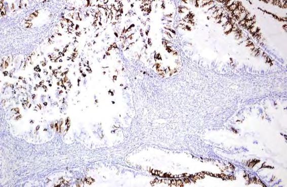 2/5/2013 Teratoma-associated: Resembles Mucinous Borderline Tumor of Surface Epithelial Type